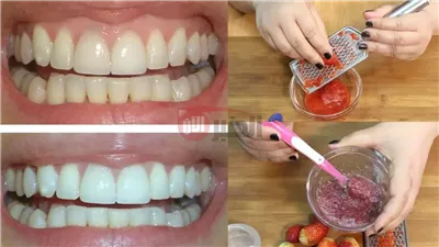 ابتسامة ناصعة بدون طبيب.. خلطات تبييض الأسنان في 5 دقائق فقط