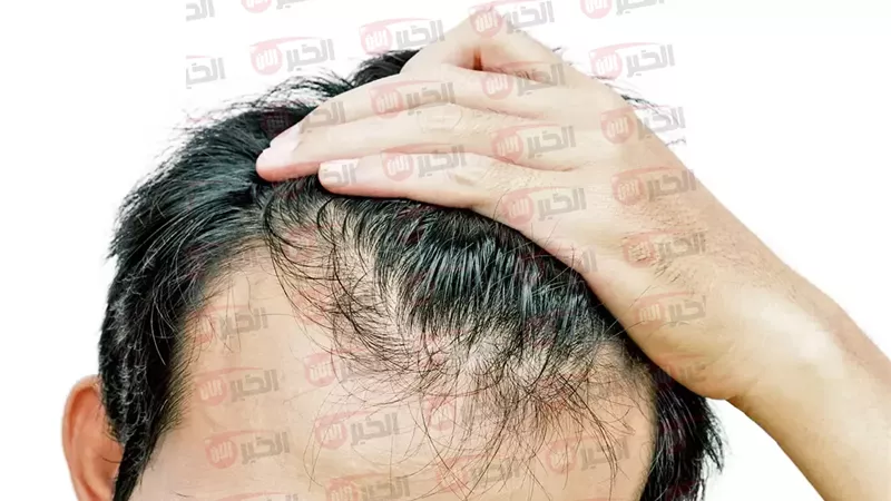 علاج سريع لتساقط