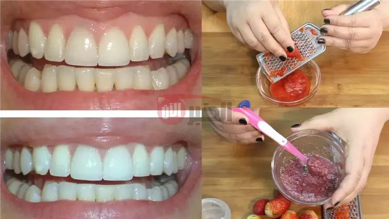 خلطات تبييض الأسنان