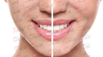 أفضل طرق إزالة آثار الحبوب والبقع الداكنة من الوجه طبيعياً 