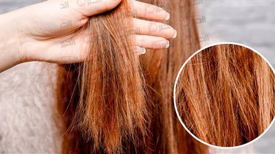 علاج الشعر الجاف والمتقصف في المنزل بوصفات طبيعية مضمونة.. ودعي التقصف نهائيًا